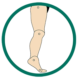 Excess Plantarflexion
