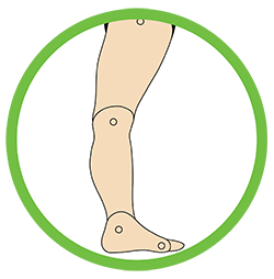 Knee Hyperextension