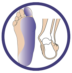 This image showcases the structure of the foot that is suffering from Low Tone Pronation