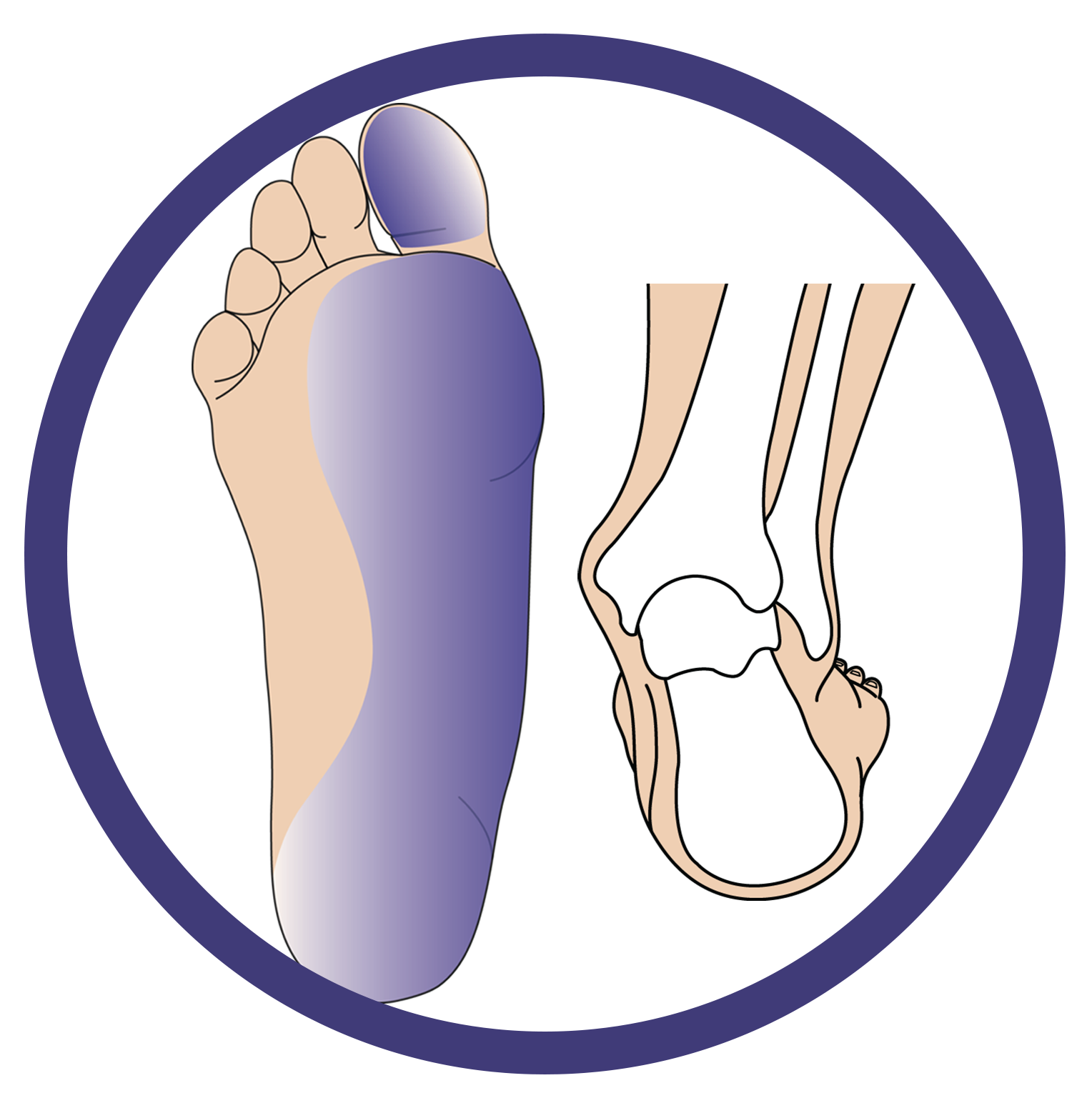 This image showcases the structure of the foot that is suffering from Low Tone Pronation