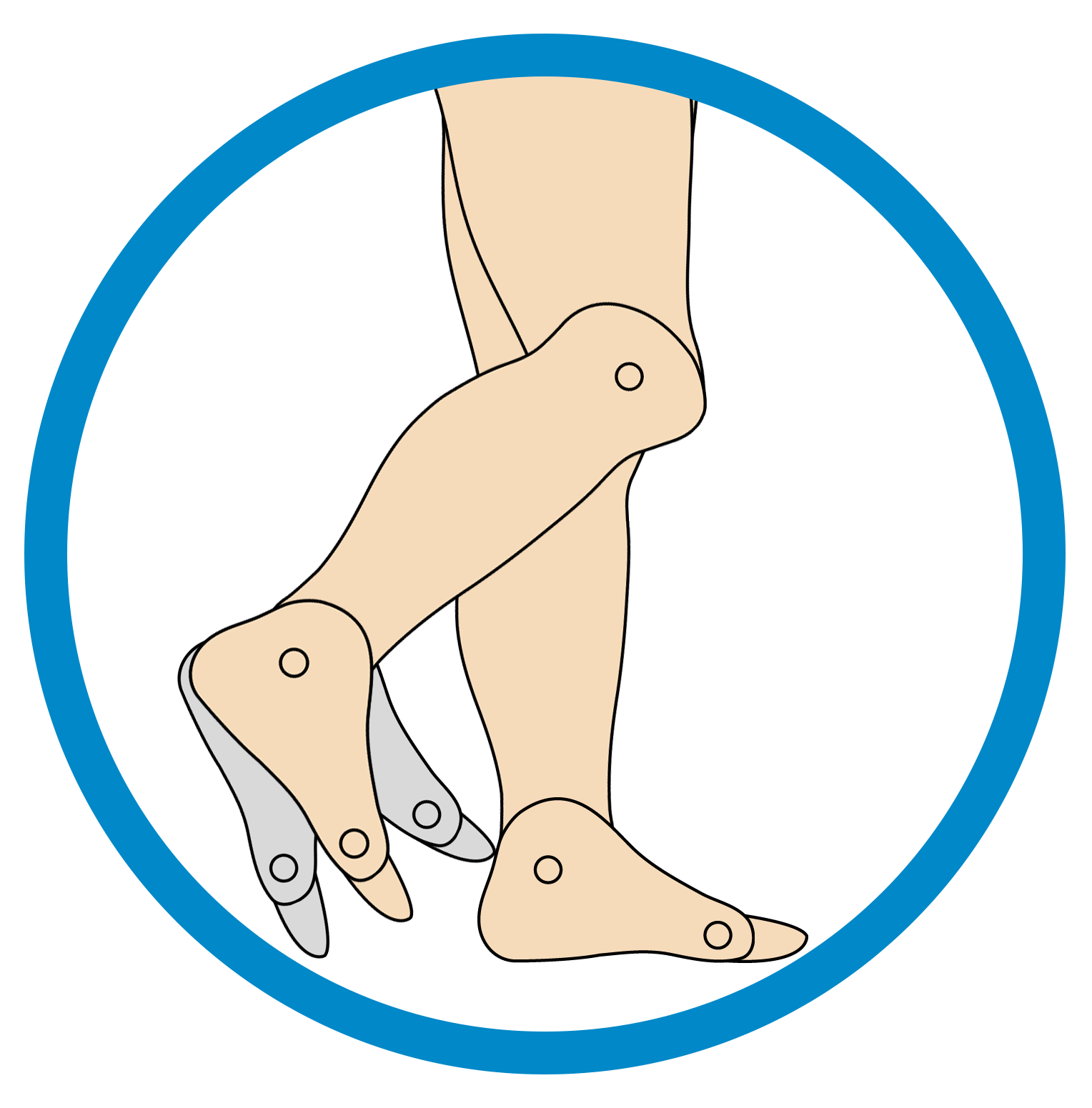 This image showcases the structure of the foot that is suffering from Swing Phase Inconsistency