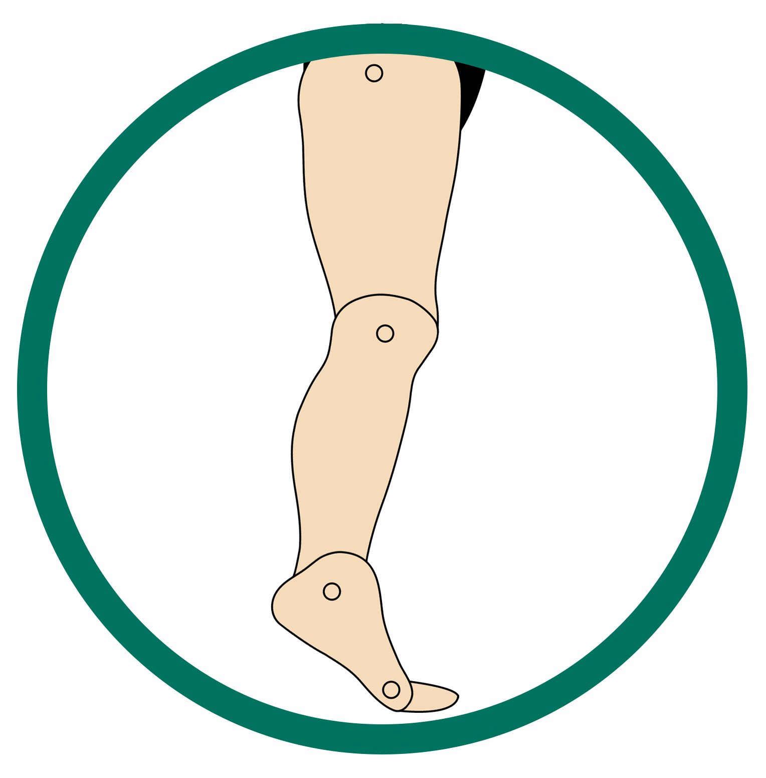 This image showcases the structure of the foot that is suffering from Excess Plantarflexion