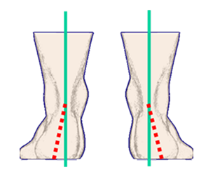 Heel eversion