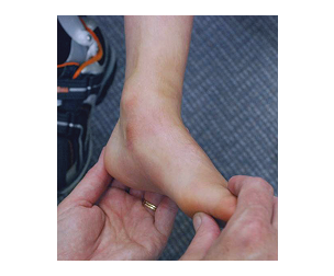 This image shows a Muscle tone of a foot
